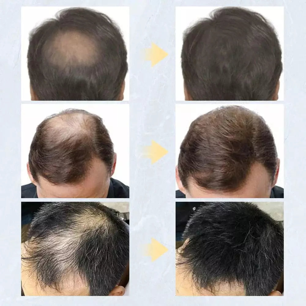 Kit Toppik Hair Fiber - Solução Para Problemas Capilares